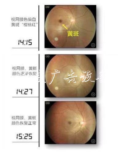 深圳30多岁IT男玩手机突户外滚动灯箱然失明 医生：系眼球中风